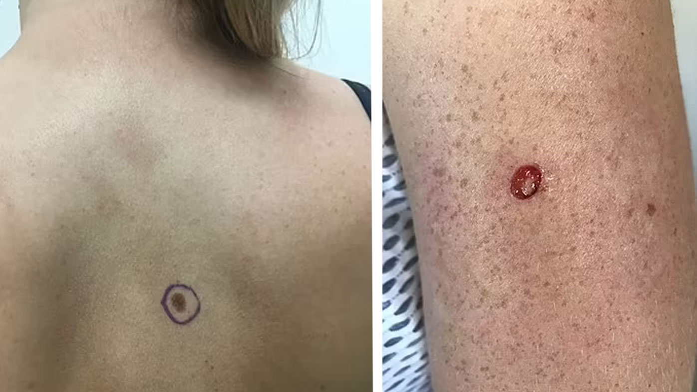 A large mole on Danielle Rancie's back turned out to be pre-cancerous. But, to her surprise, her doctor picked up a tiny spot on her arm, which was a stage-2 melanoma. 