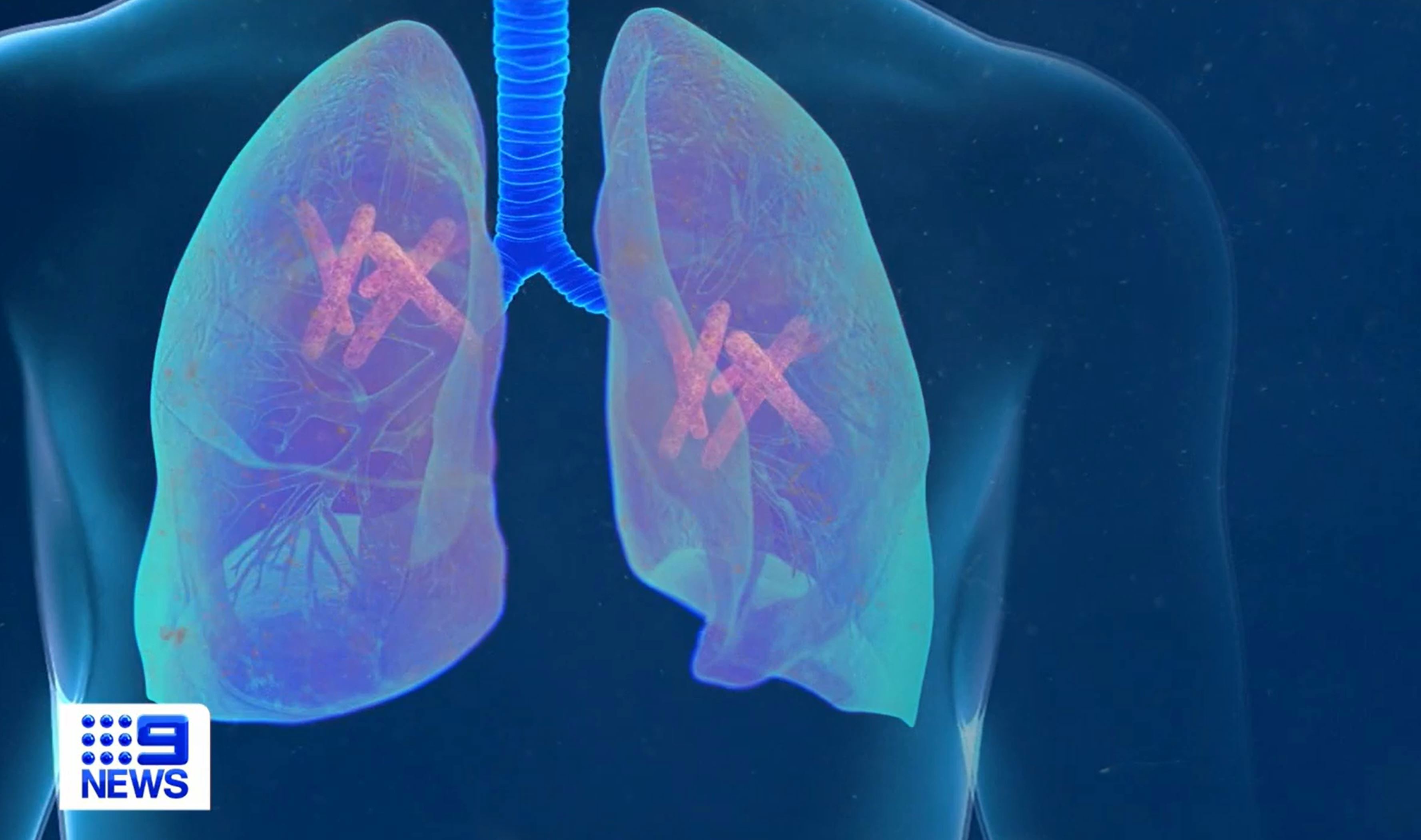 Deadly disease overtakes COVID-19 as leading global infectious killer