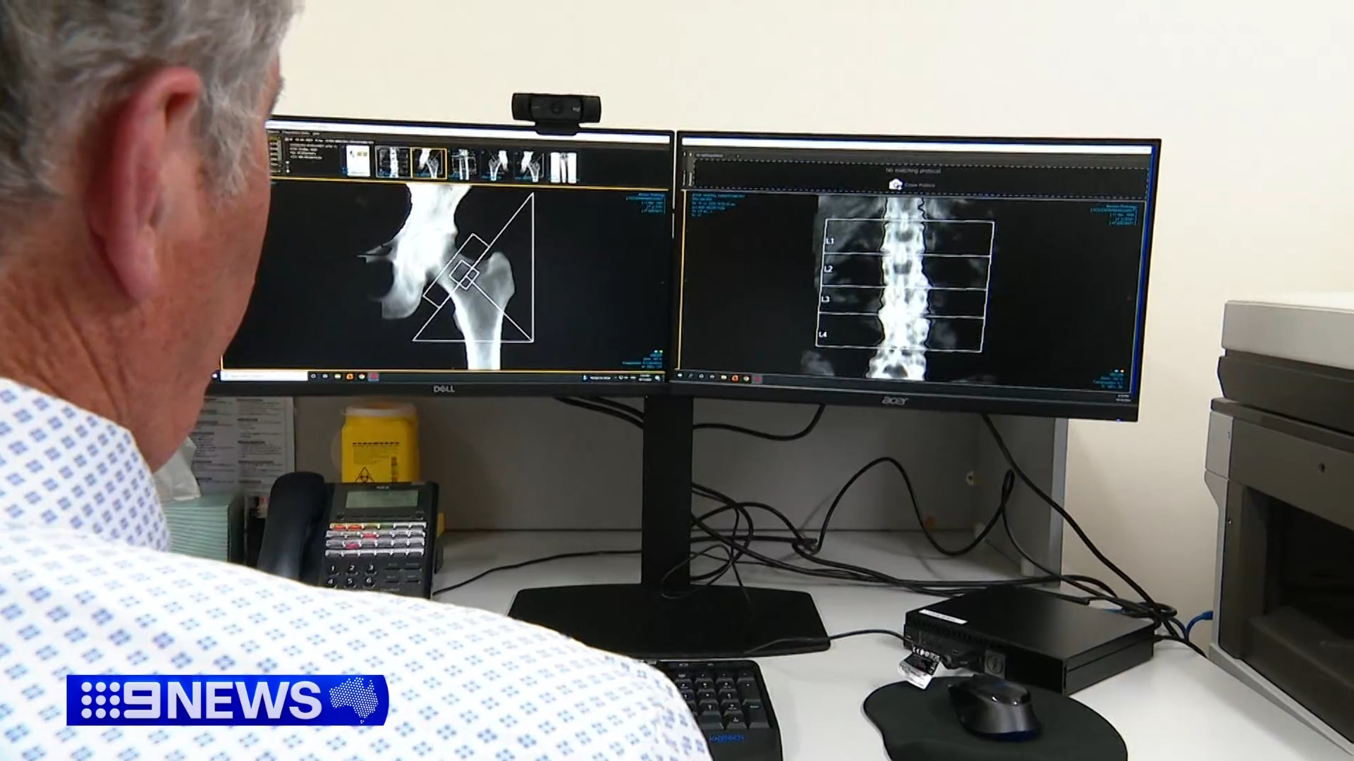 Thousands more Aussies to get access to osteoporosis treatment