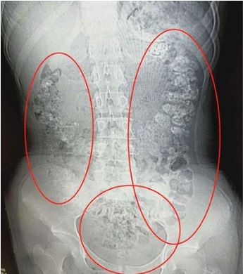 X-ray shows similar incident in 2019 where doctors found more than 100 undigested tapioca balls inside a girl's stomach. 