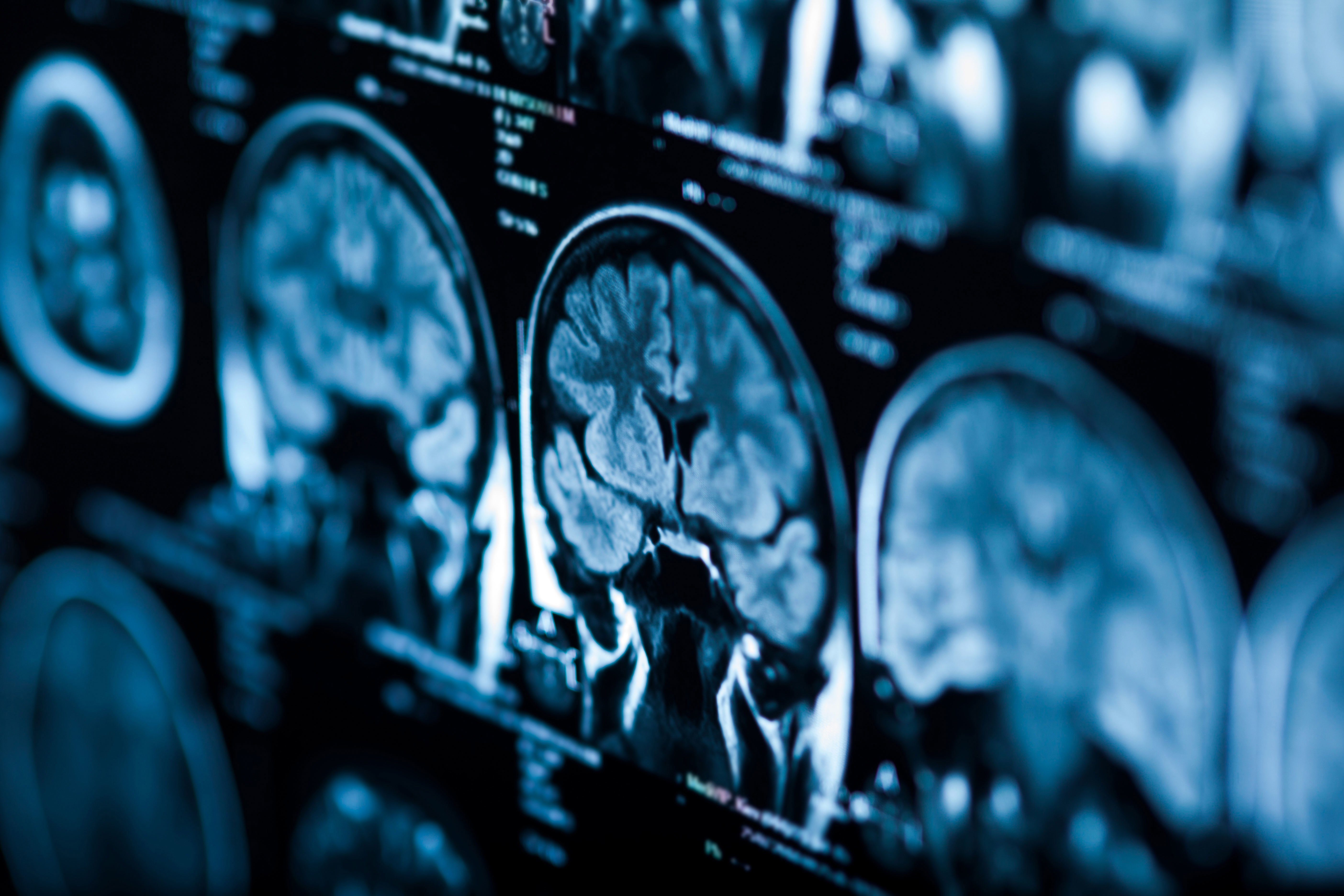 Aussie researchers claim new way to treat Alzheimer’s disease