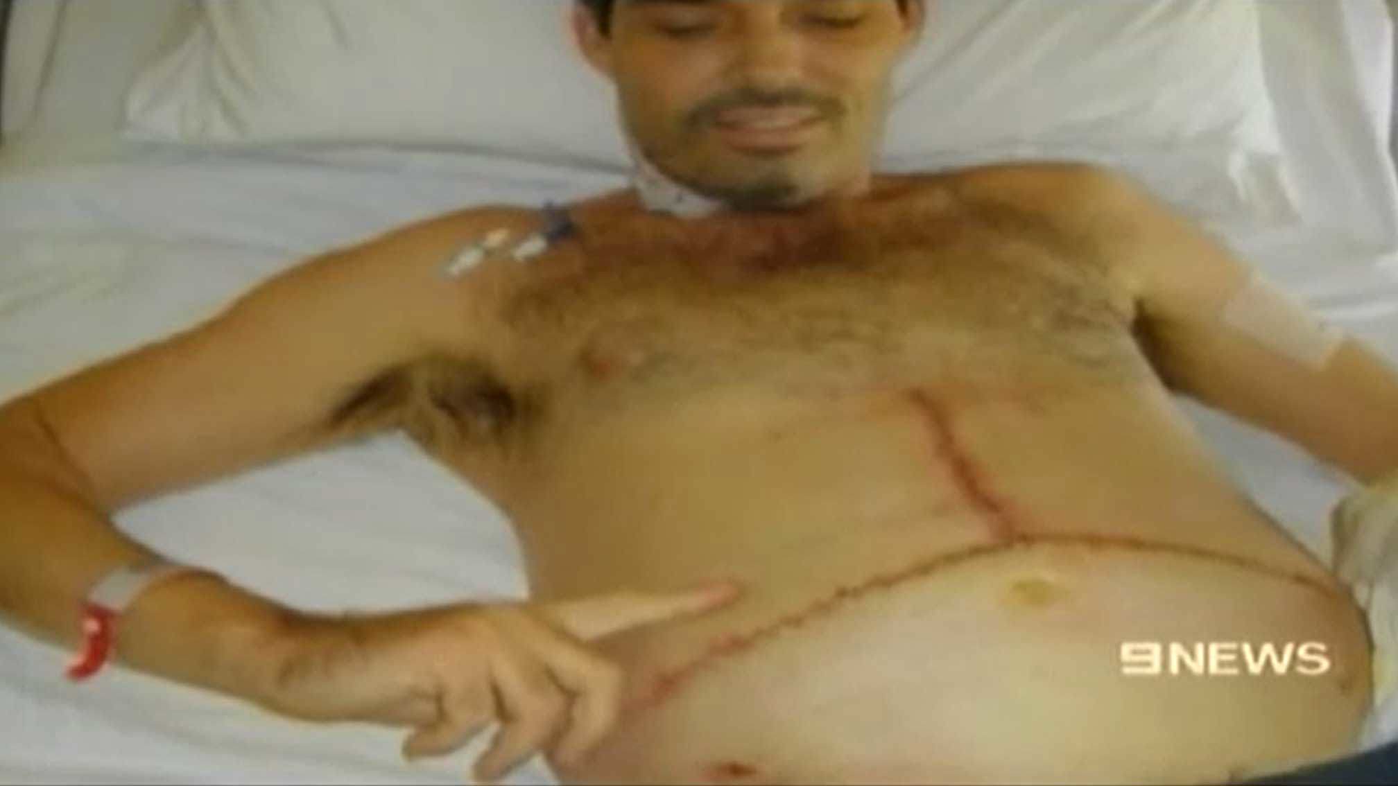 Tony David, pictured after his first liver transplant in 2009.