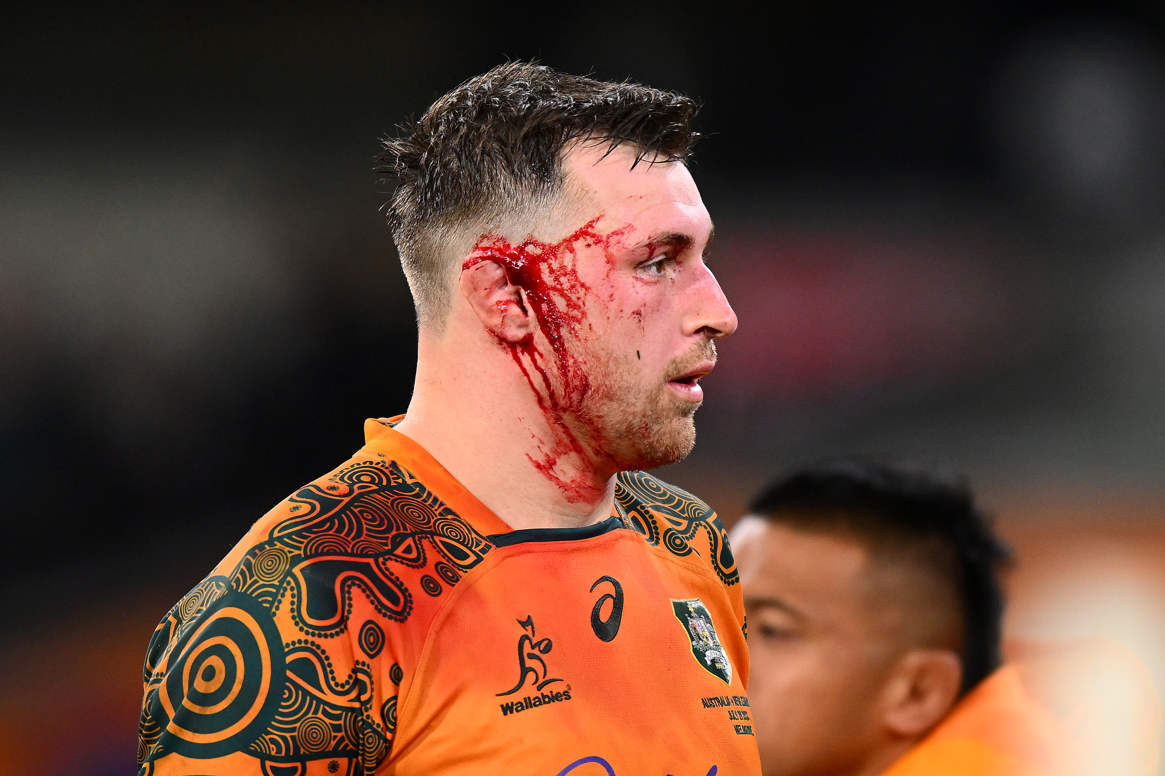 Nick Frost of the Wallabies with his ear injury at the MCG.