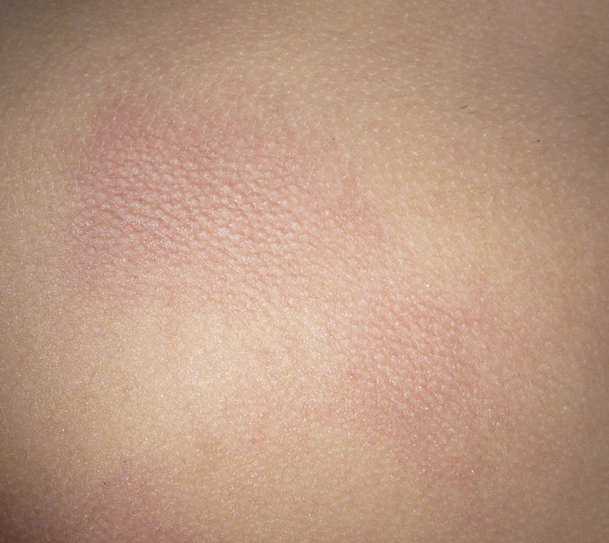 Despite the extreme pain they cause Irukandji stings leave relatively delicate marks.