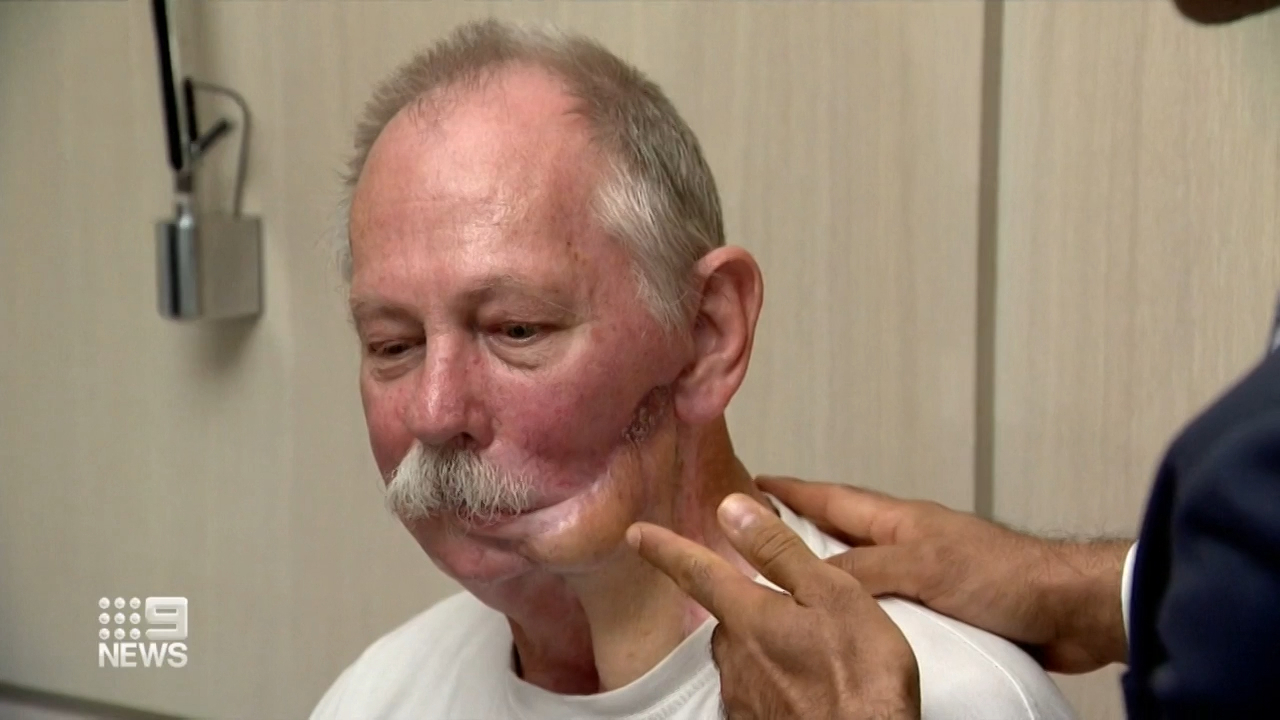 Doctors print cancer survivor a new jaw