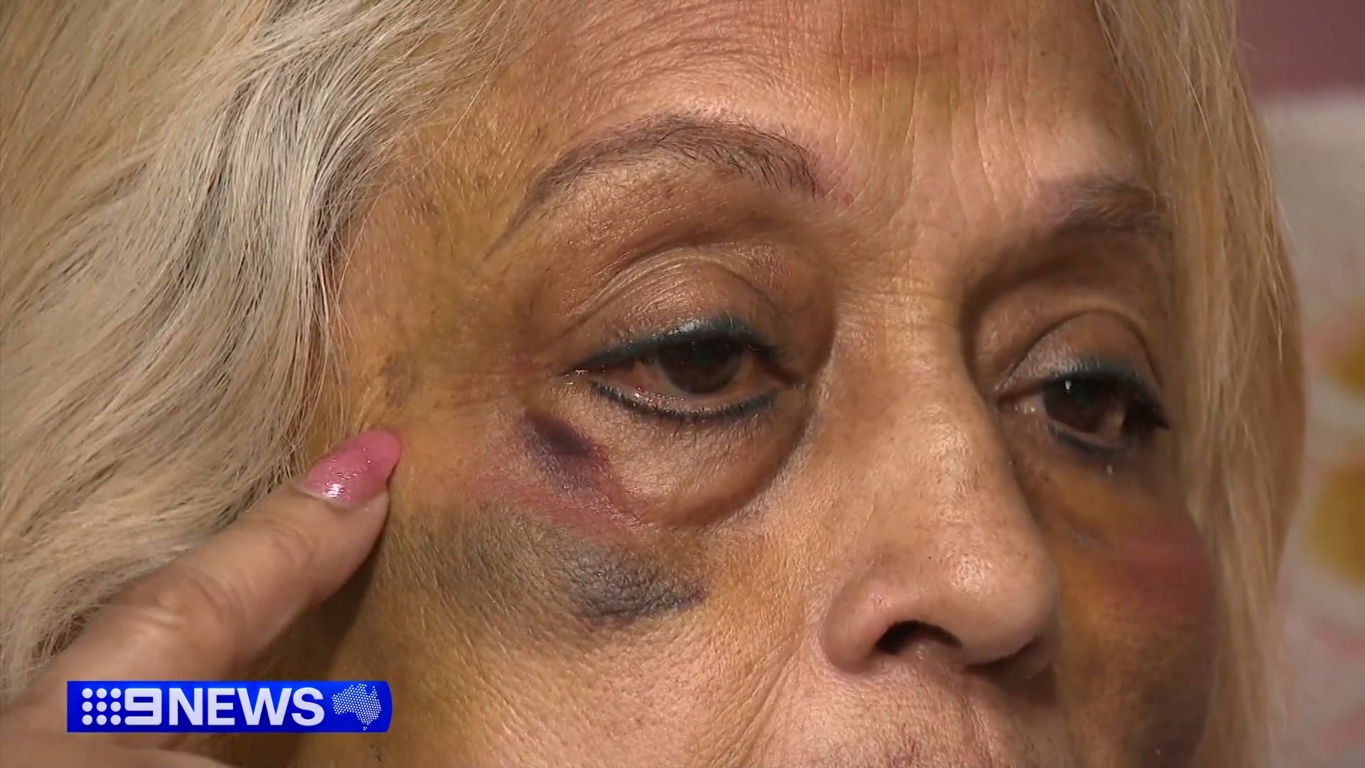 Ninette Simons is still bruised but is bravely sharing her story and pleading for help in finding her attackers, with the three men behind the incident still at large.