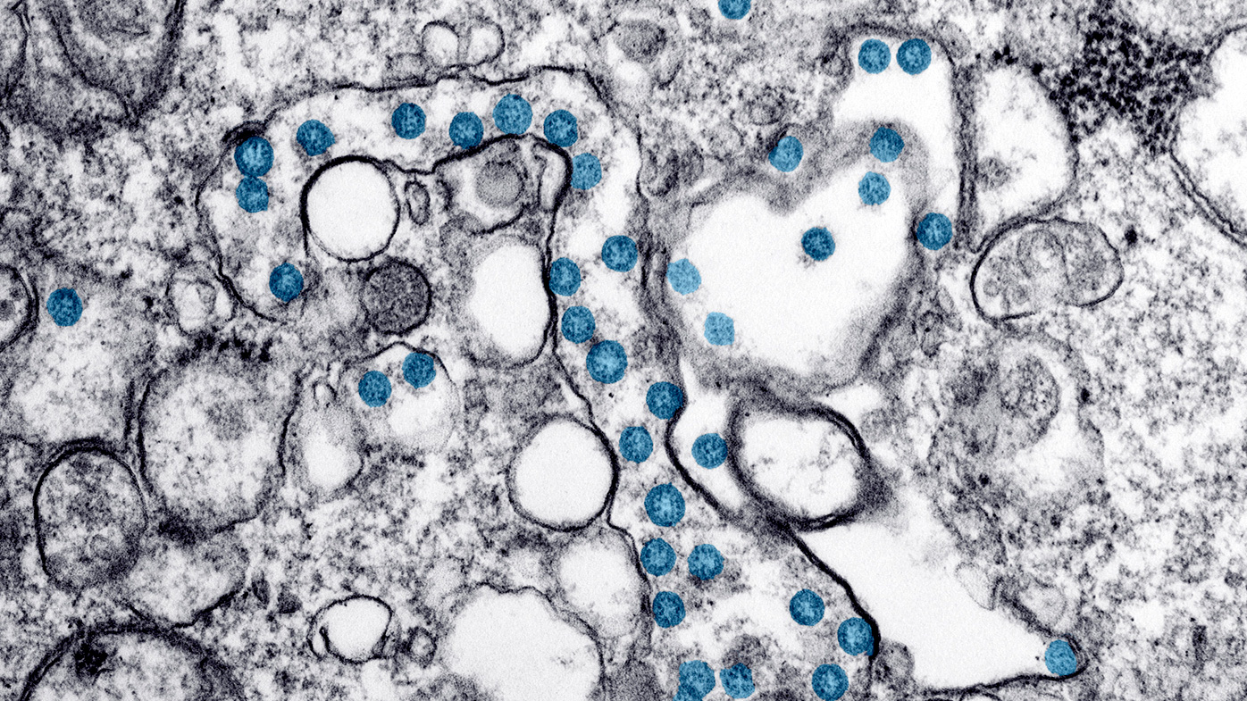 An electron microscope image shows the spherical particles of the new coronavirus, coloured blue, from the first US case of COVID-19.