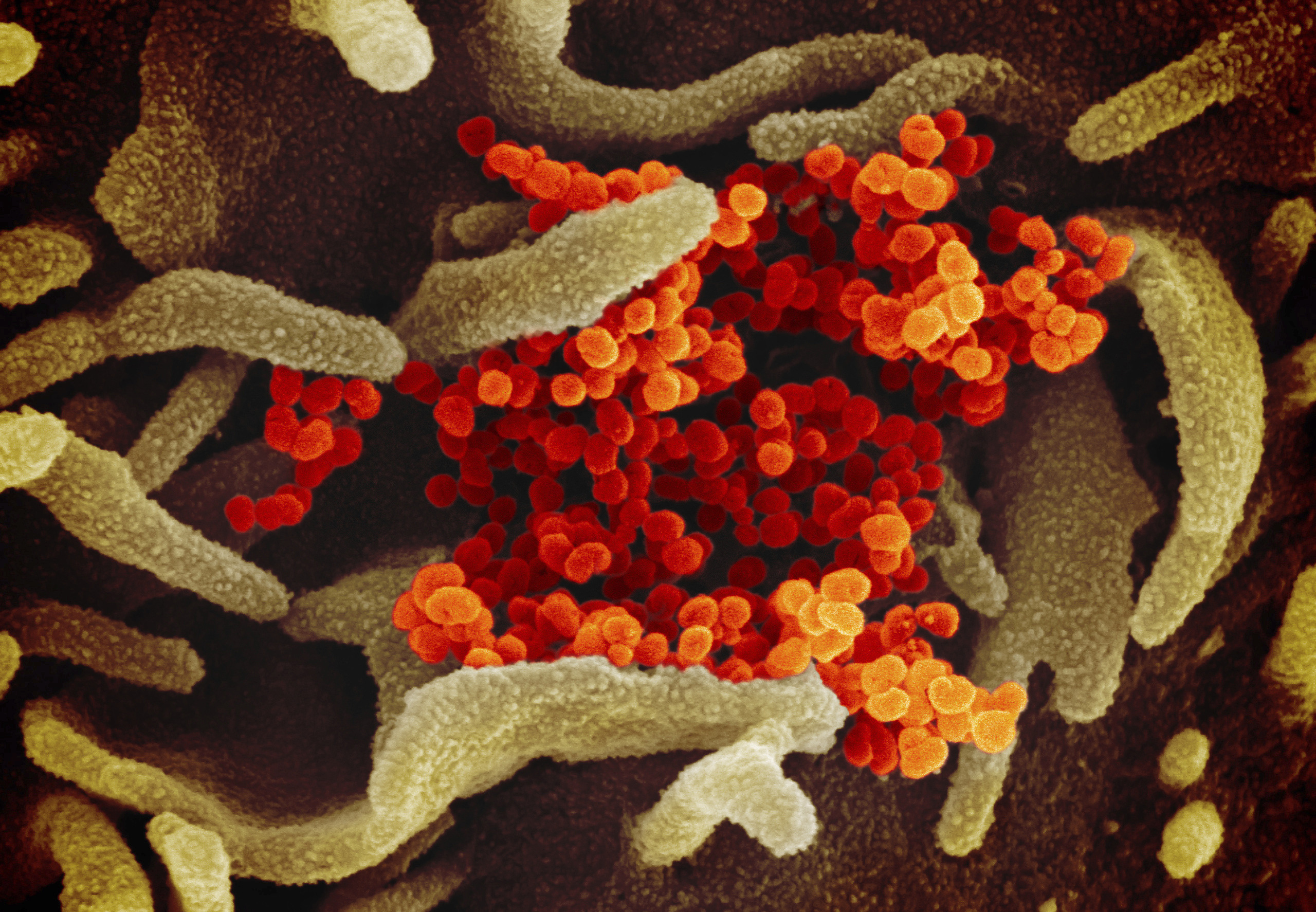 The Novel Coronavirus SARS-CoV-2, orange, emerging from the surface of cells, green, cultured in the lab. Also known as 2019-nCoV, the virus causes COVID-19. The sample was isolated from a patient in the United States.