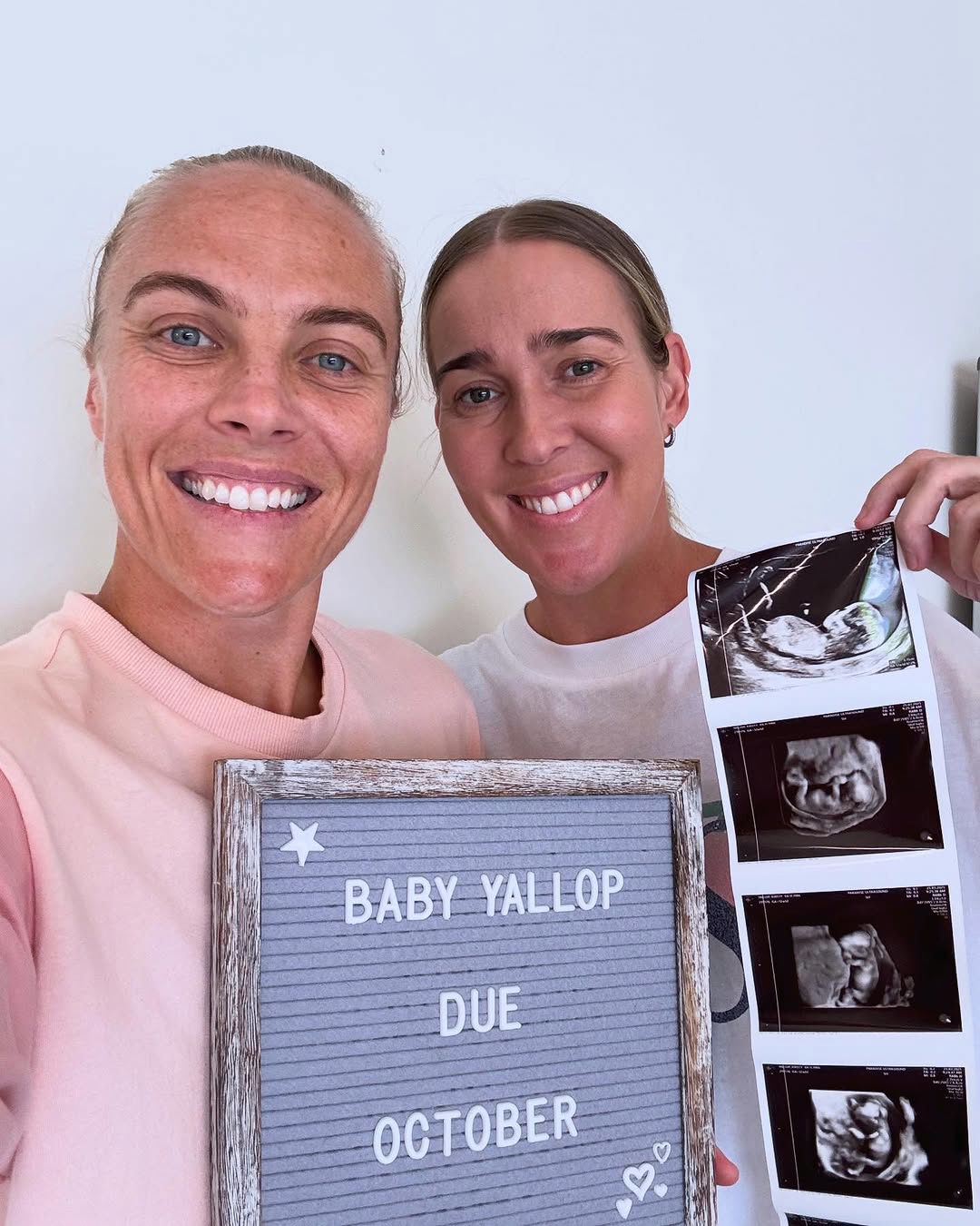 Tameka Yallop and Kirsty Yallop expecting second child