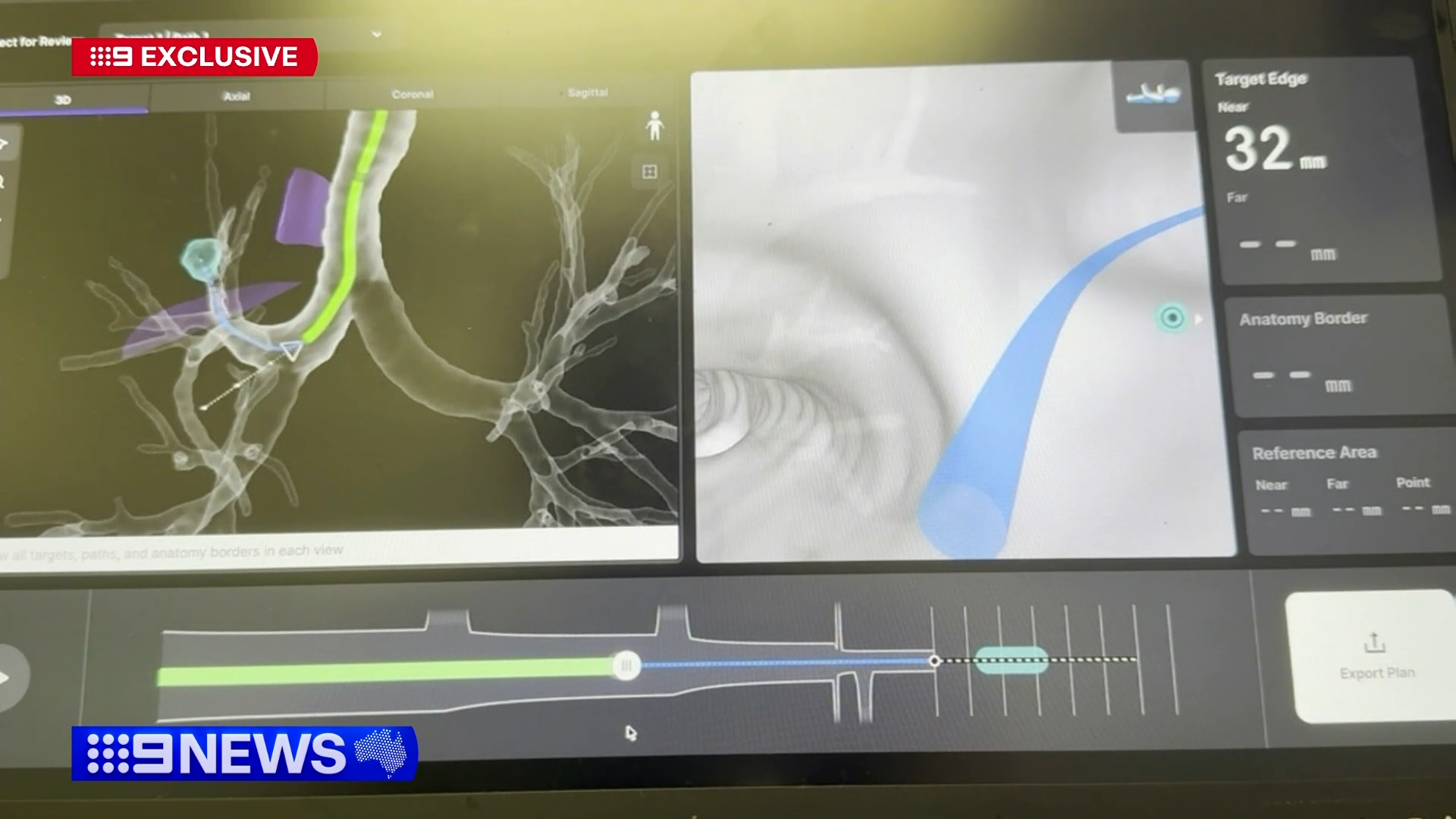 Revolutionary robot, called 'ION', to improve lung cancer early detection