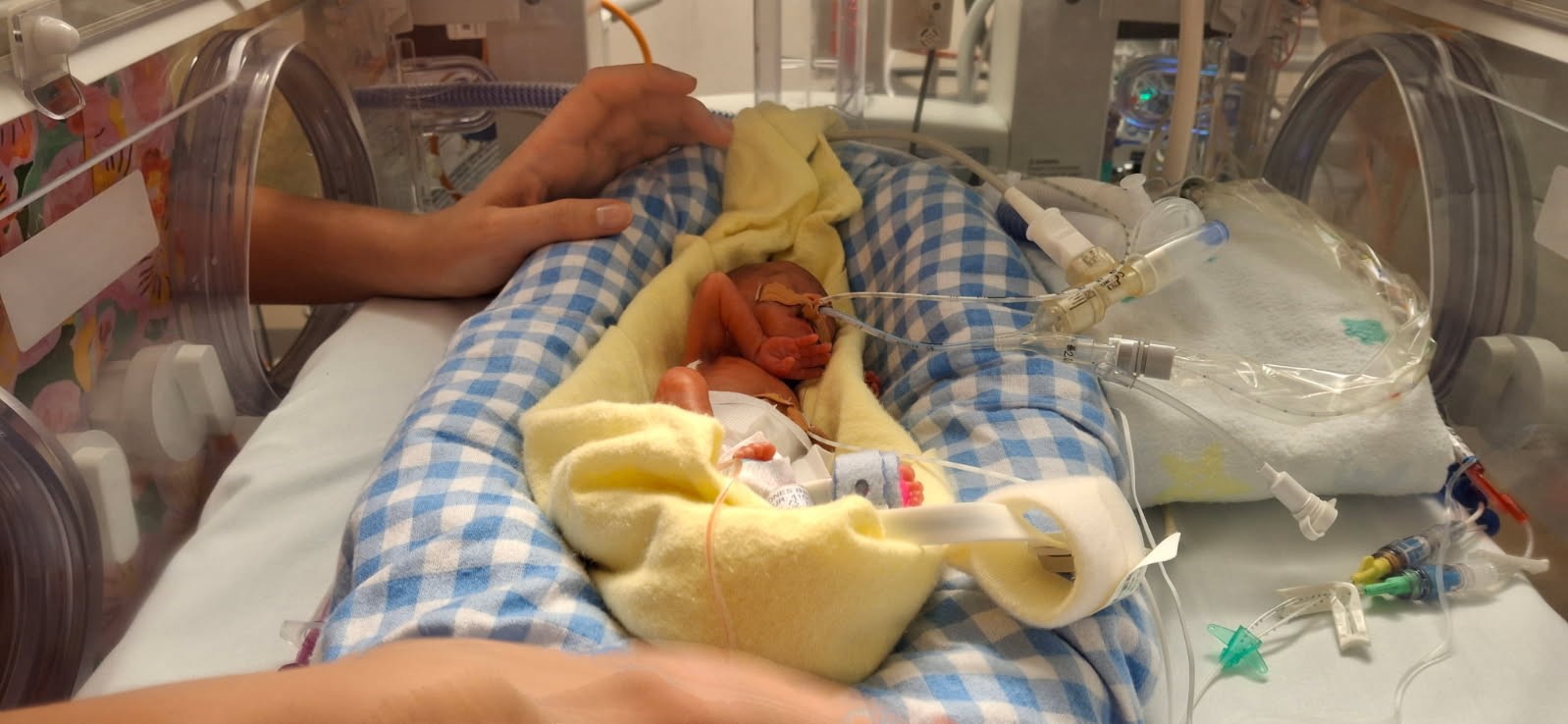 baby Charlie Jones is Queensland's smallest newborn