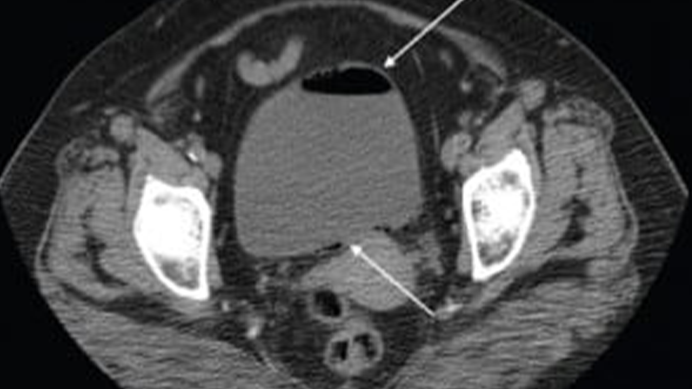 An Abdominal CT showing a complicated UTI with arrows indicating damage to the bladder walls (file). UTI's are caused when microorganisms, usually bacteria, enter the urethra or bladder. 