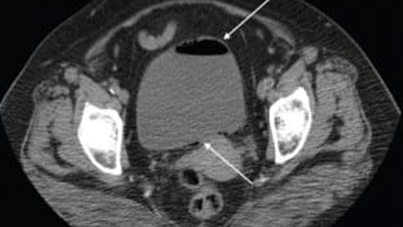 An Abdominal CT showing a complicated UTI with arrows indicating damage to the bladder walls (file). UTI's are caused when microorganisms, usually bacteria, enter the urethra or bladder.