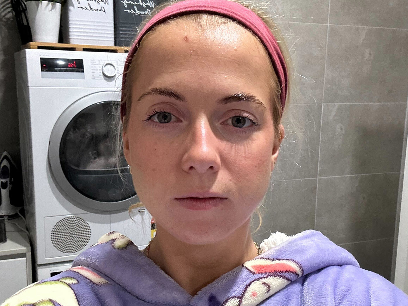The pink spot on Rachael's head turned out to be skin cancer.