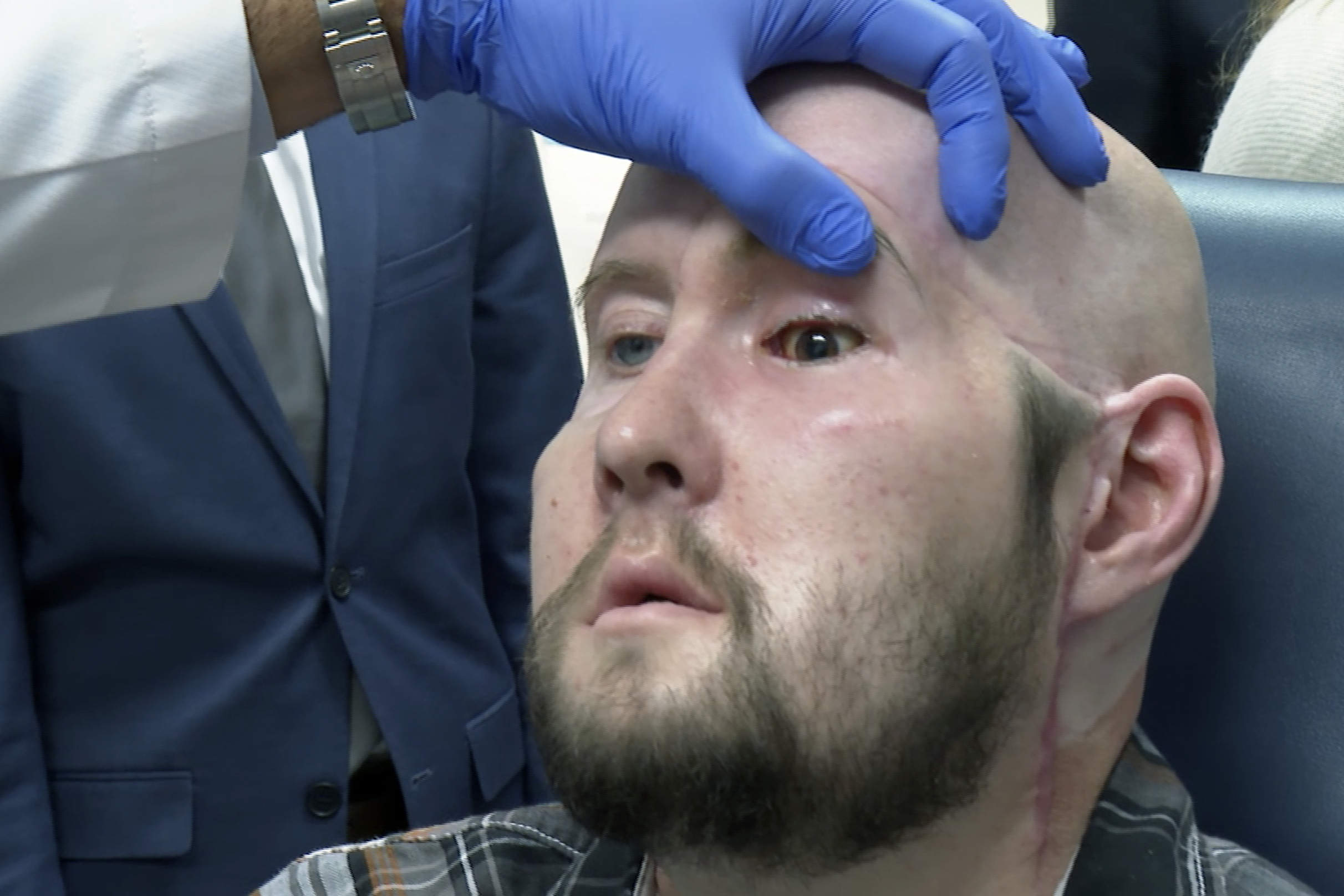 El primer trasplante de ojos del mundo acerca la cura de la ceguera "un paso más cerca"