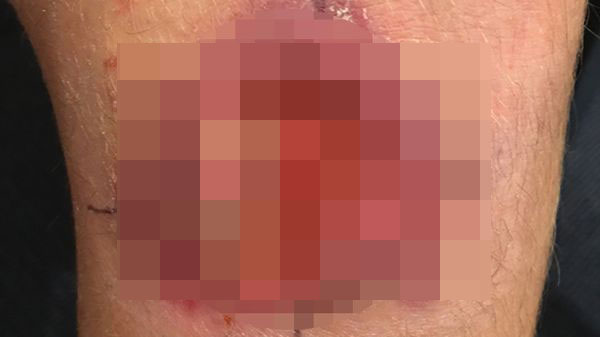 flesh eating ulcer