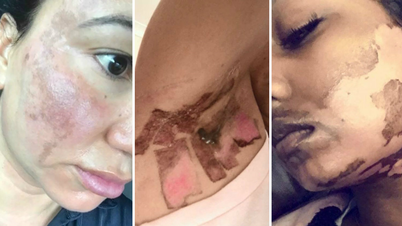 Laser hair removal burns: Woman left with burns following laser gone wrong