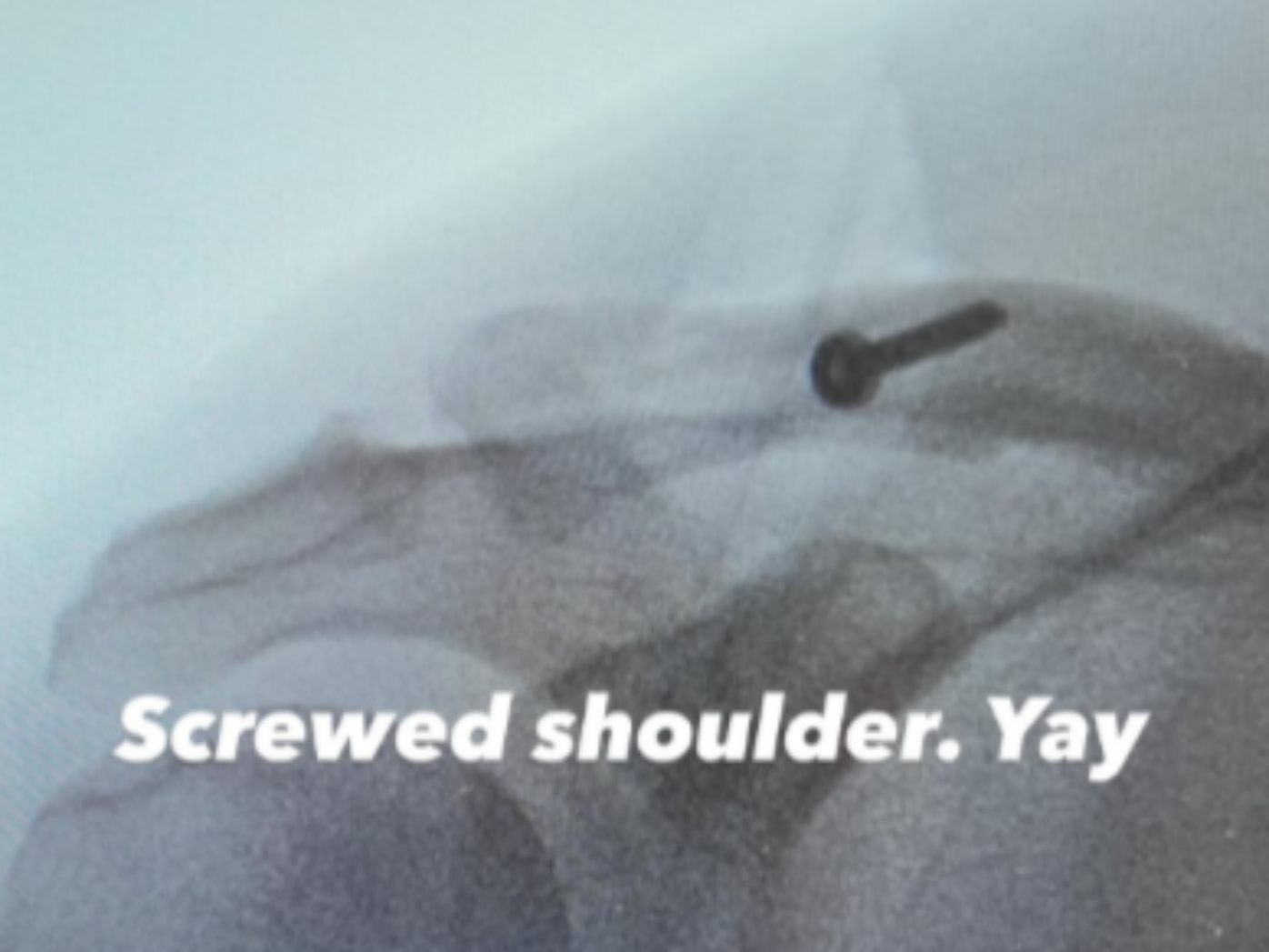 Channing Tatum shares X-ray images before and after shoulder surgery