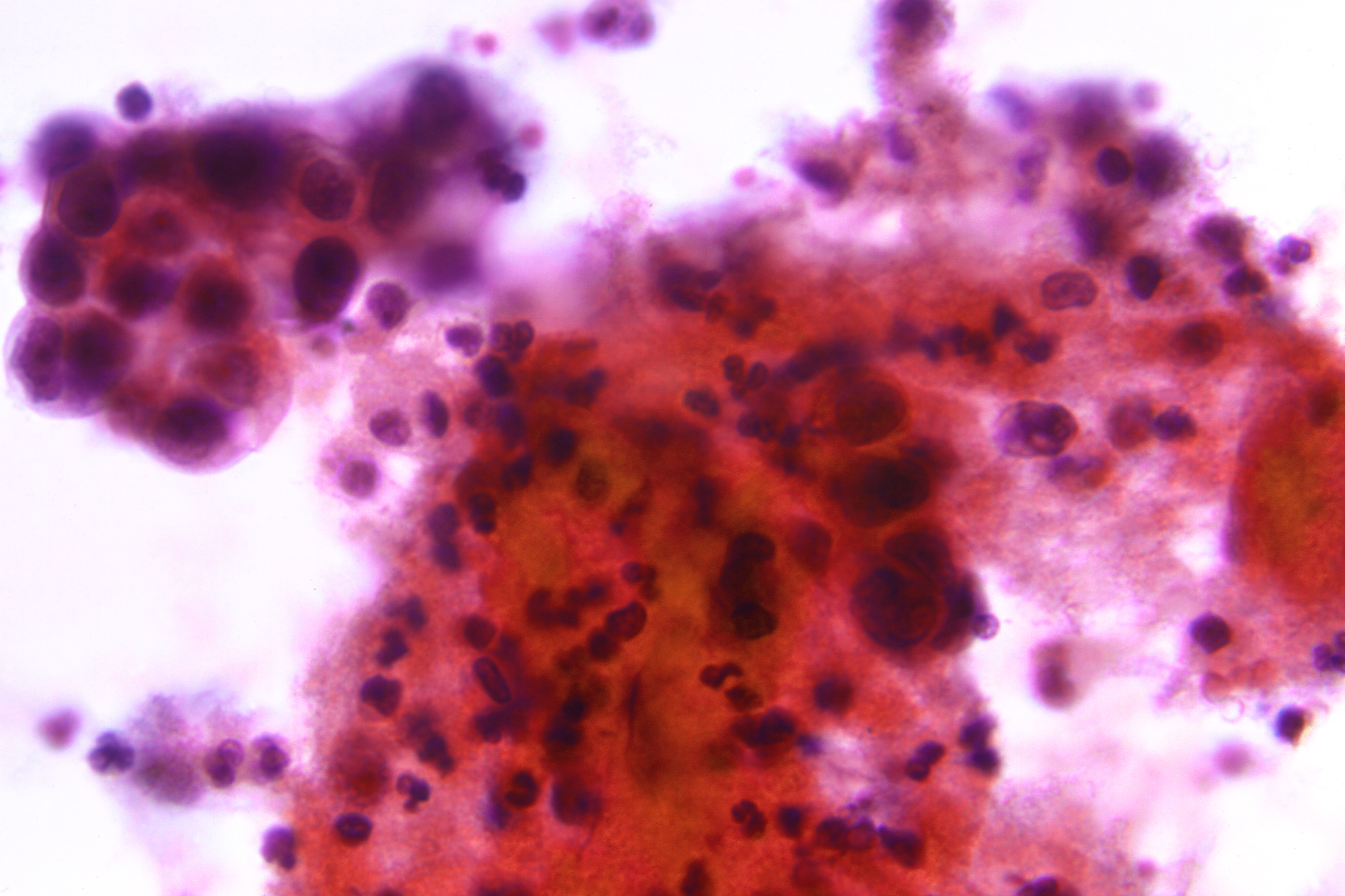 Photo shows positive result from pap smear of cervical cancer. 