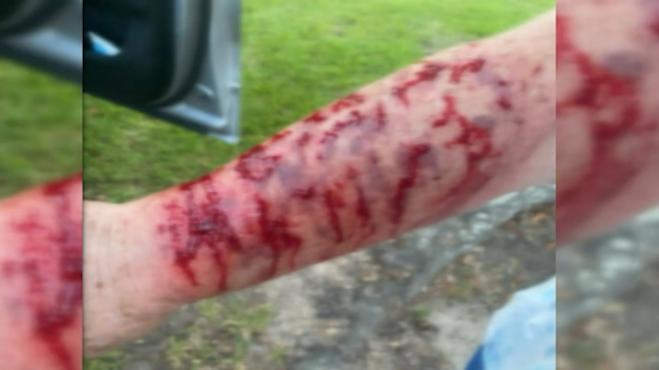 The hawk divebombed to  grab the snake, leaving her arm a bloodied mess.