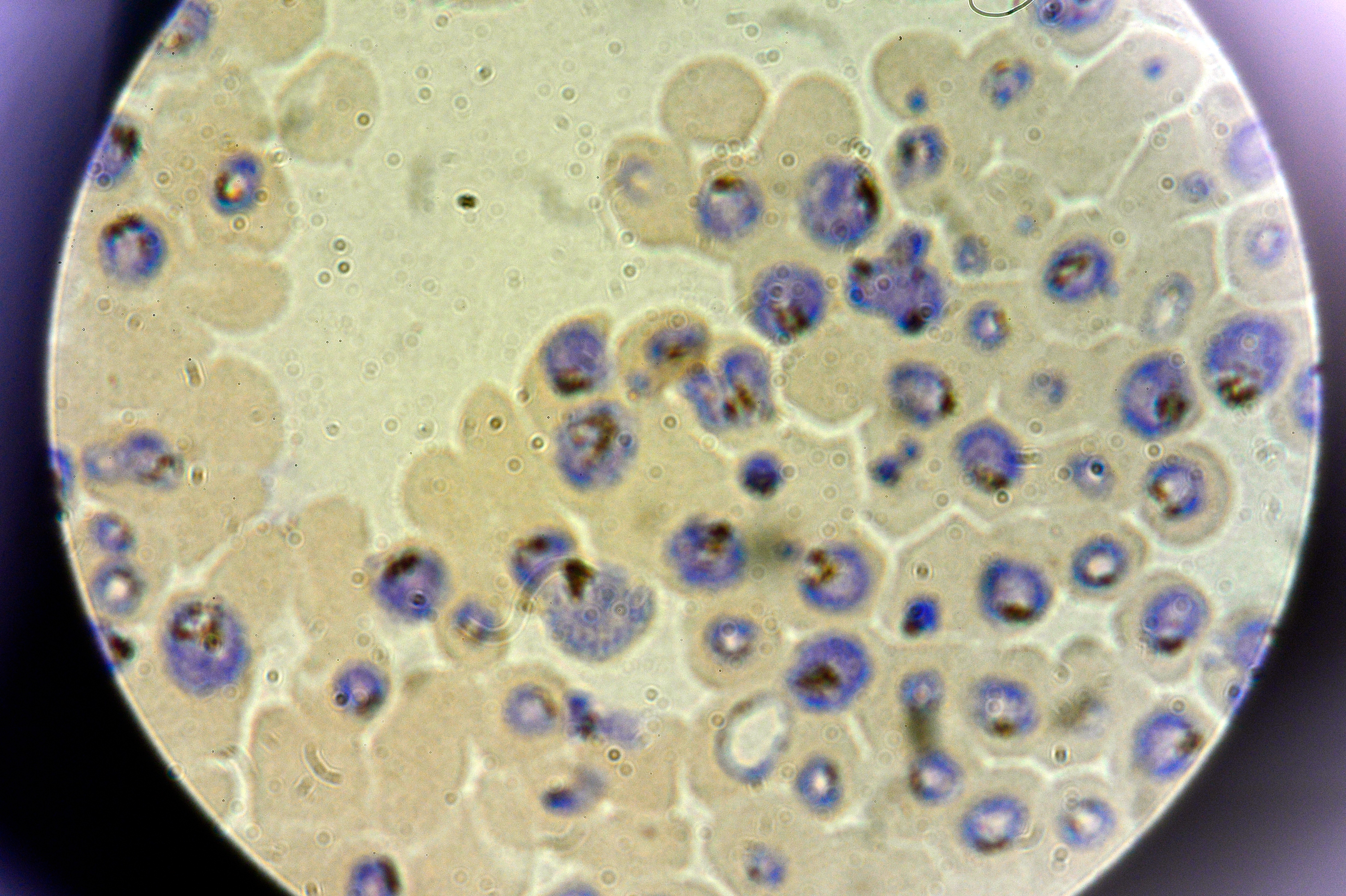 Plasmodium falciparum, one of the five parasites that causes malaria, shown growing in human red blood cells. 