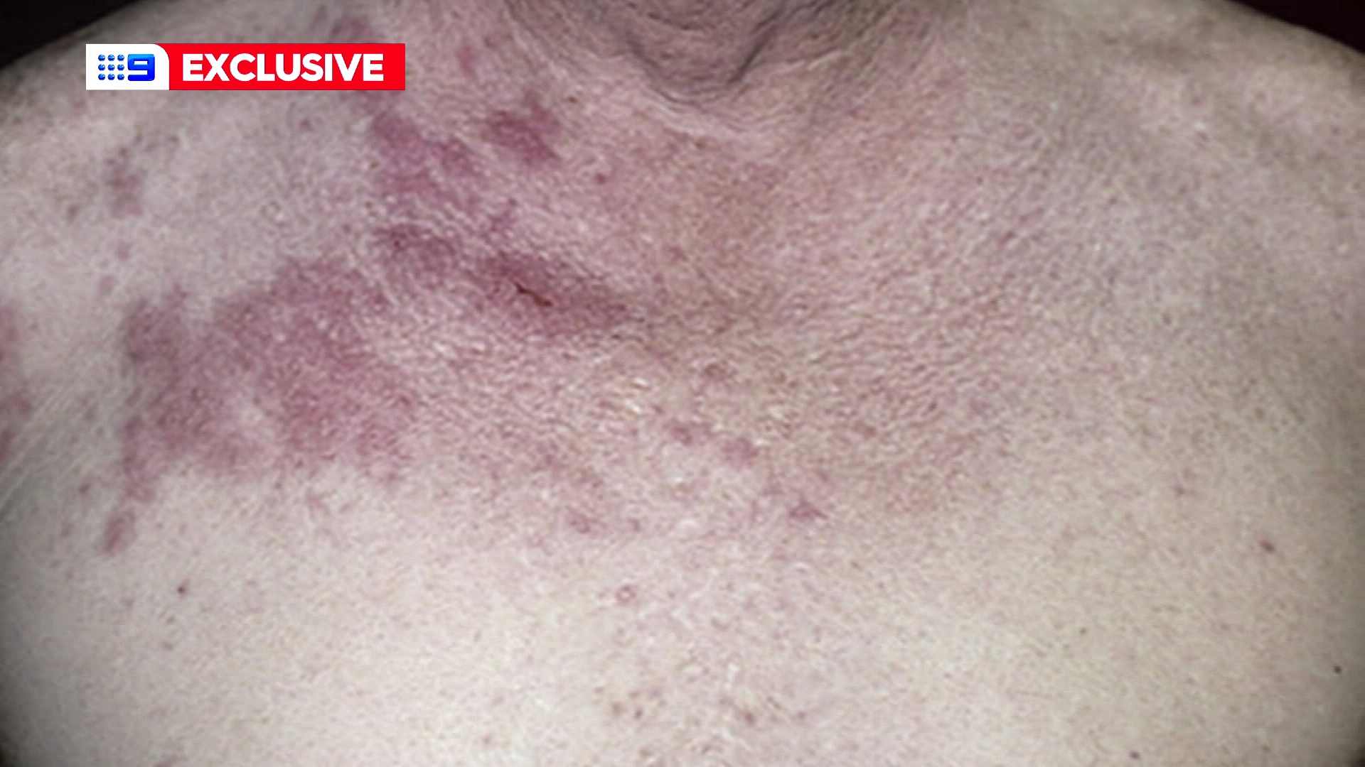 Shingles can appear as a blistering rash in those who've previously had chickenpox.
