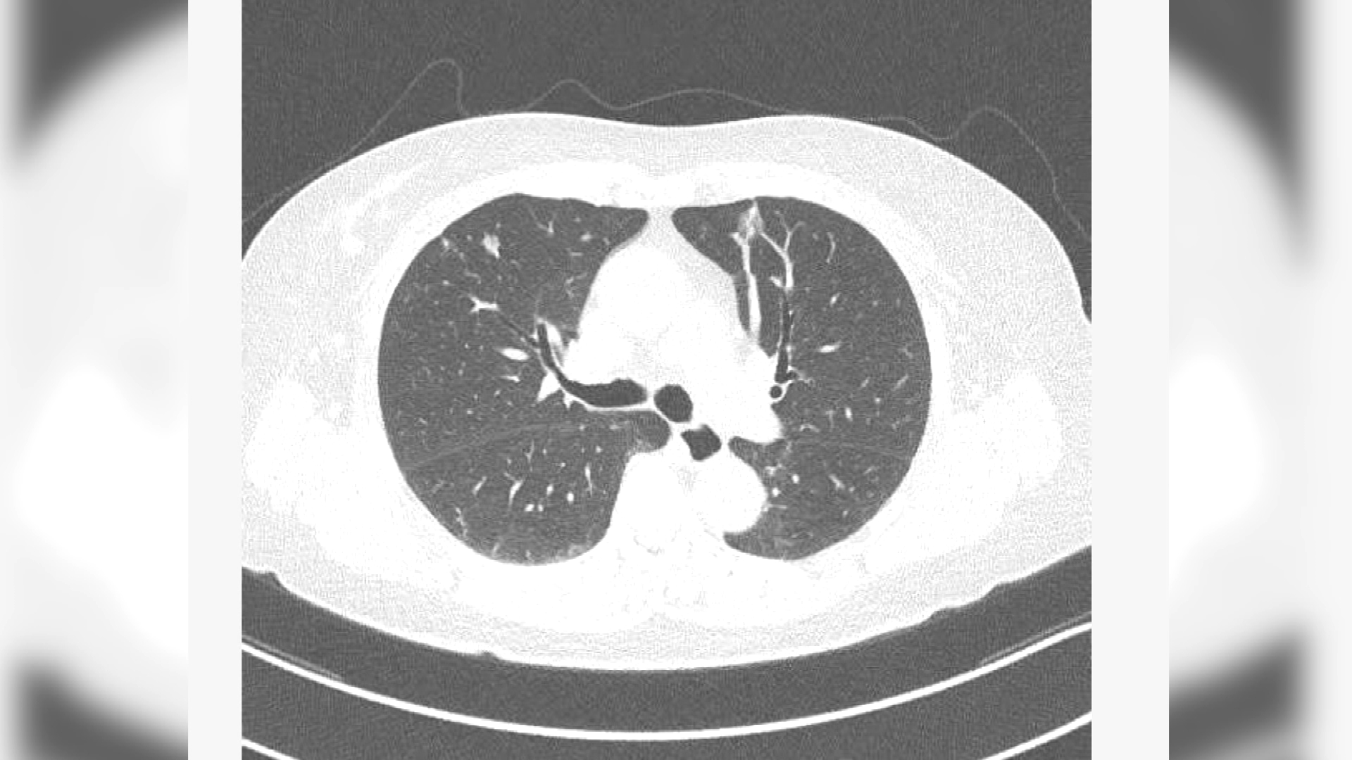 New treatment for lung cancer