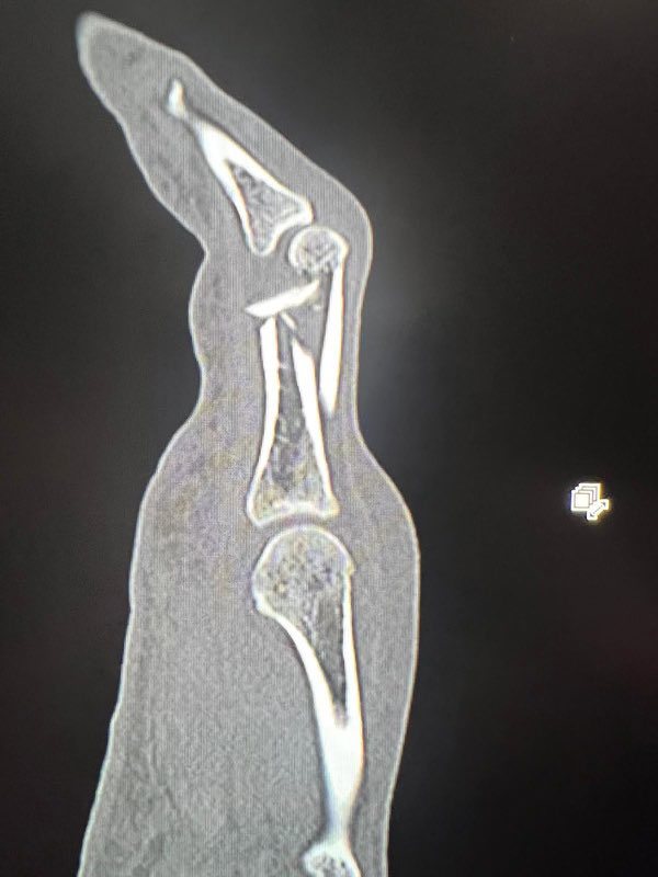 X-Ray image of Viliame Kikau's compound fracture. 