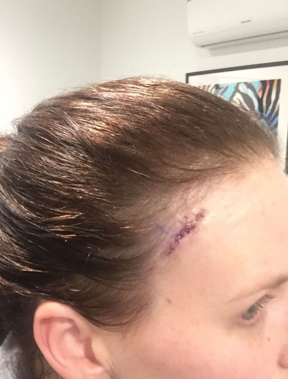 Skin cancer story- Melbourne woman Sara