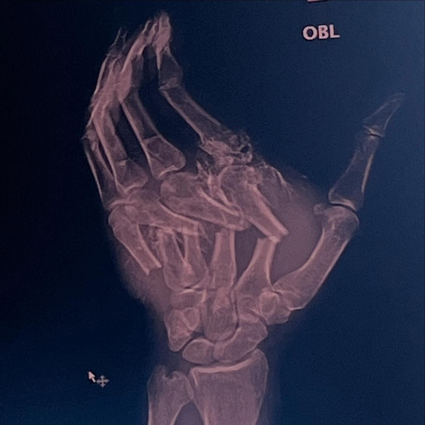 Manu Bennett hand X-ray