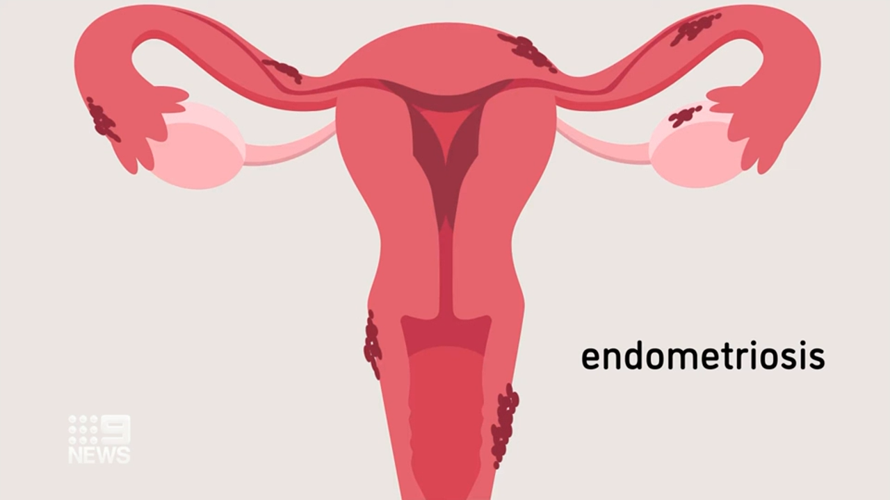 Endometriosis occurs when tissue, similar to the lining of the uterus, infiltrates nearby organs and causes inflammation, swelling and scarring.