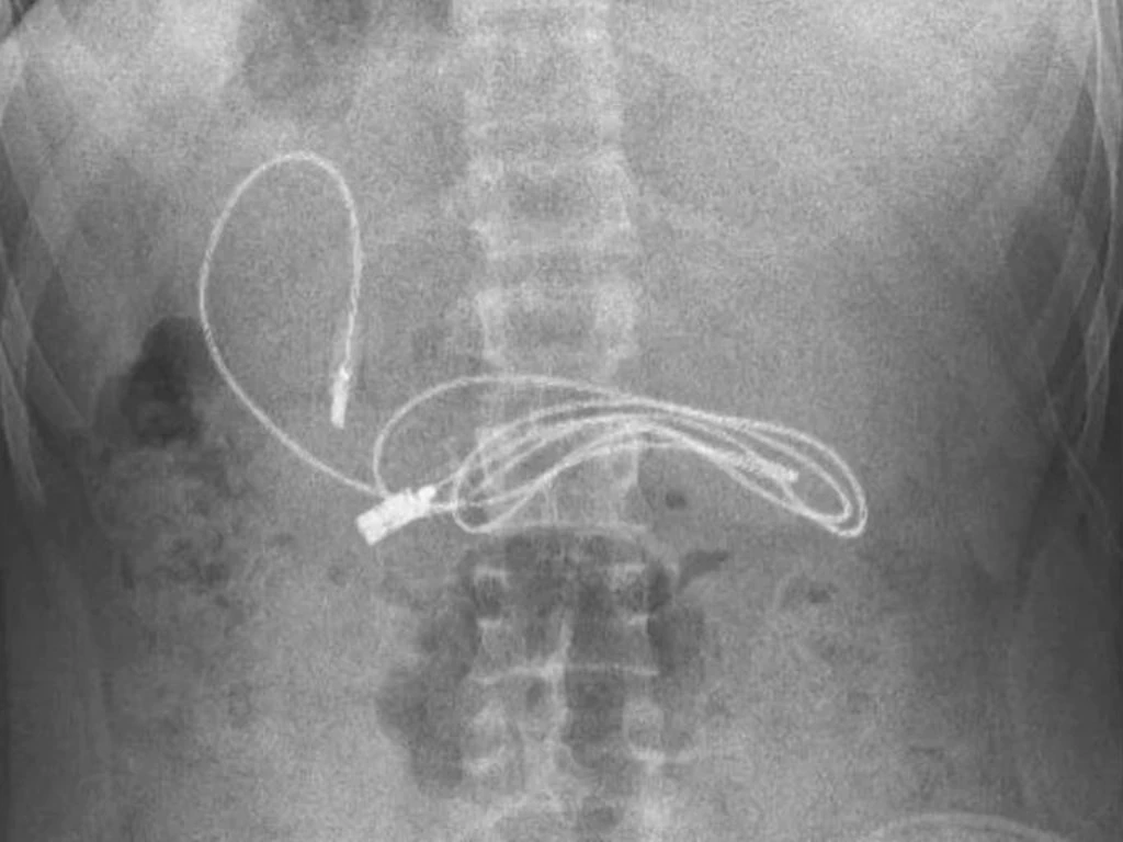 A charging cord measuring almost a metre was found inside a teen boy from Turkey.