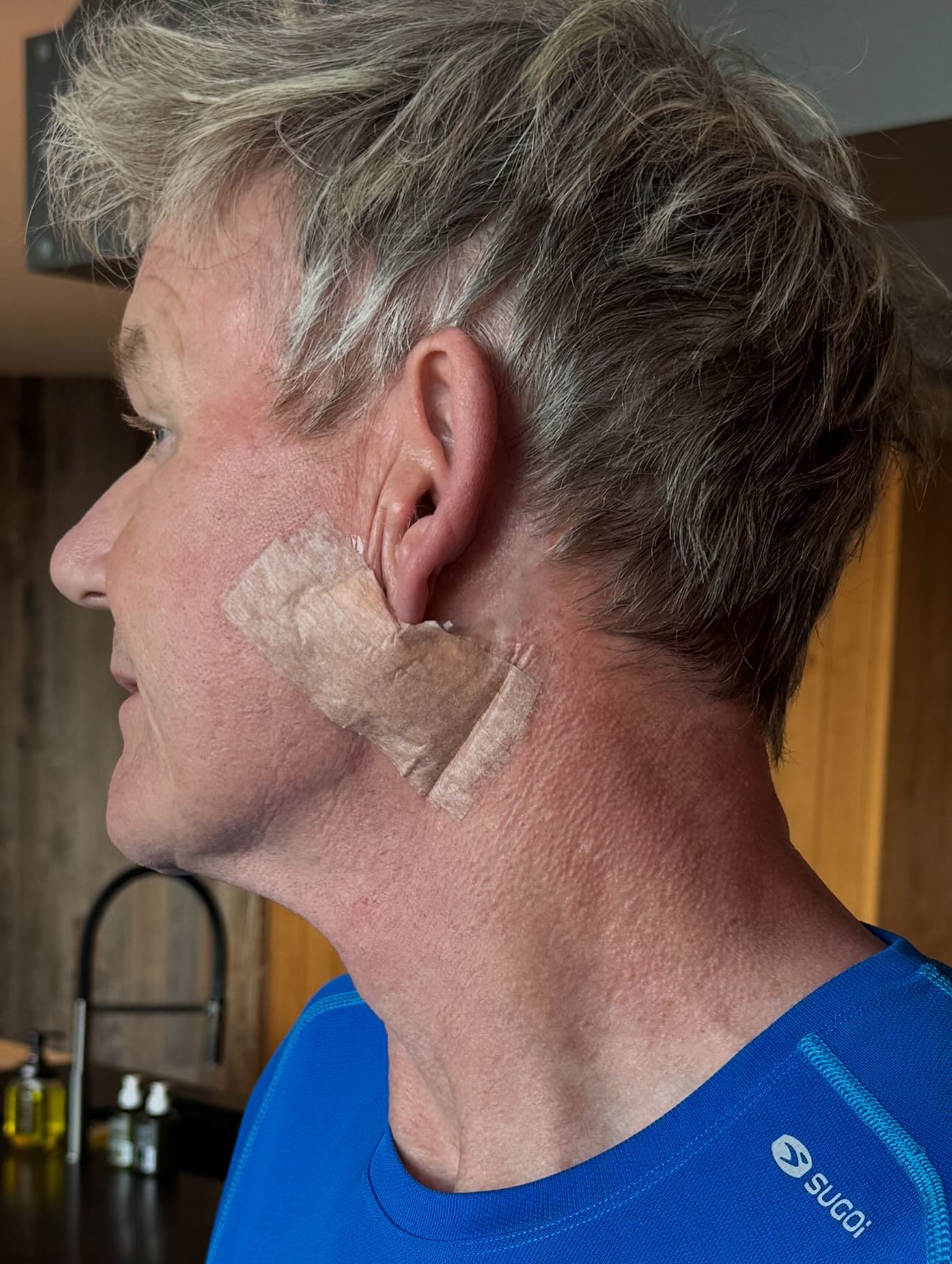 Gordon Ramsay skin cancer surgery