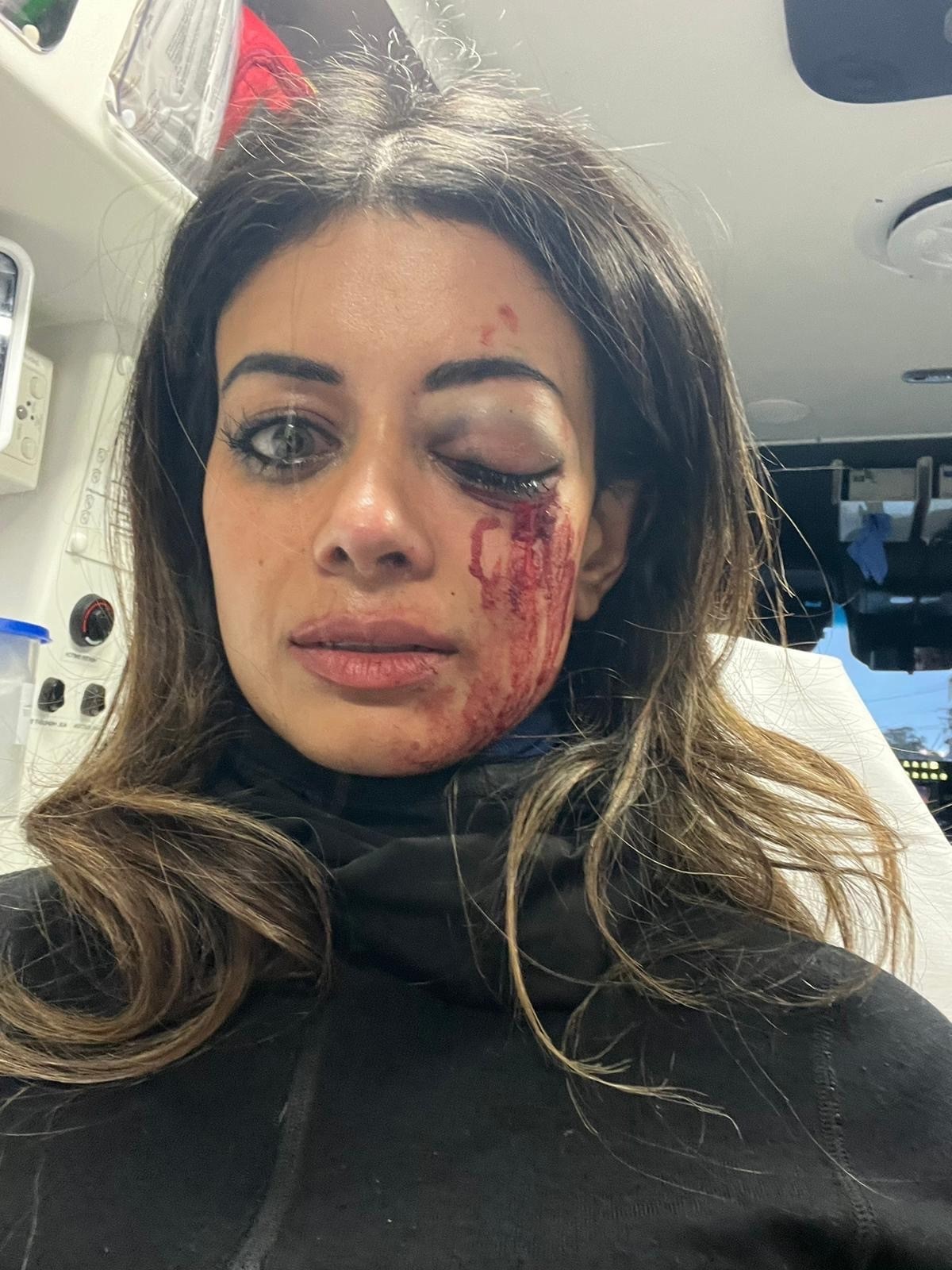 Images show Hannah bruised with a bloodied eye.﻿