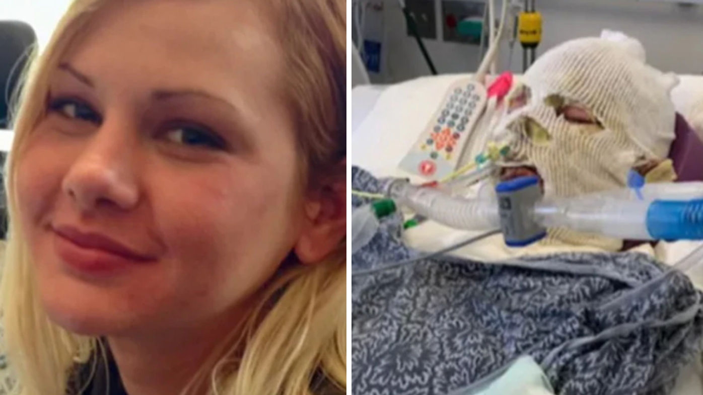 Alyssa Morales, de 36 años, sufrió quemaduras en el 60 por ciento de su cuerpo.  Su madre dijo que su rostro nunca volverá a ser el mismo.