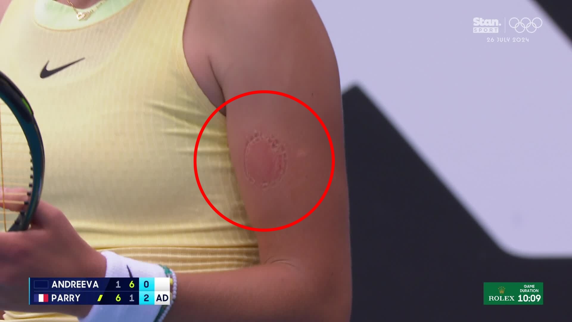 Mirra Andreeva reveals a huge bite mark on the insider of her bicep.