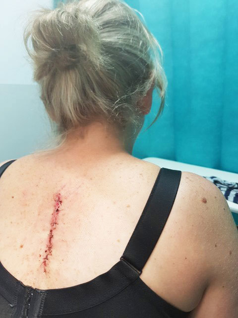 A scar showing where a melanoma and surrounding skin tissue was removed from Gillian Jenkins' back four years ago.