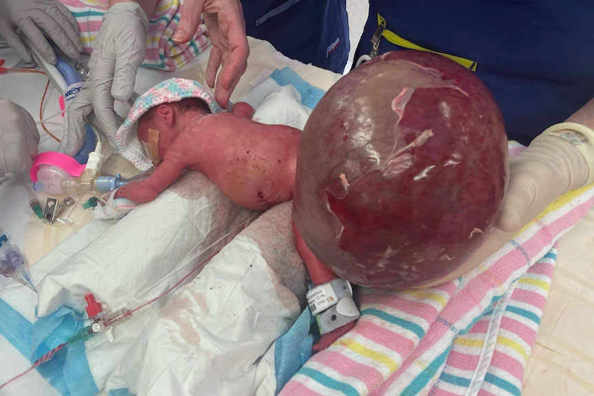 The tumour was double Saylor's birth weight.