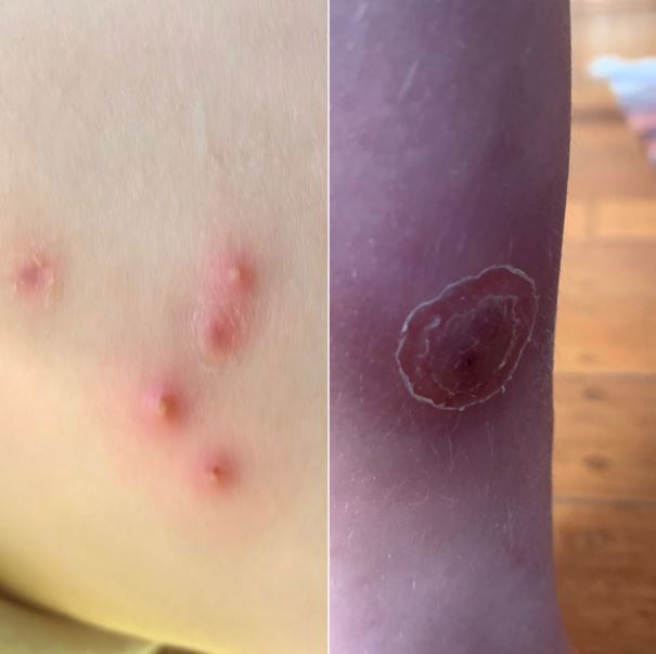 The family left the mould-riddled property in September last year after the children developed angry sores on their arms.