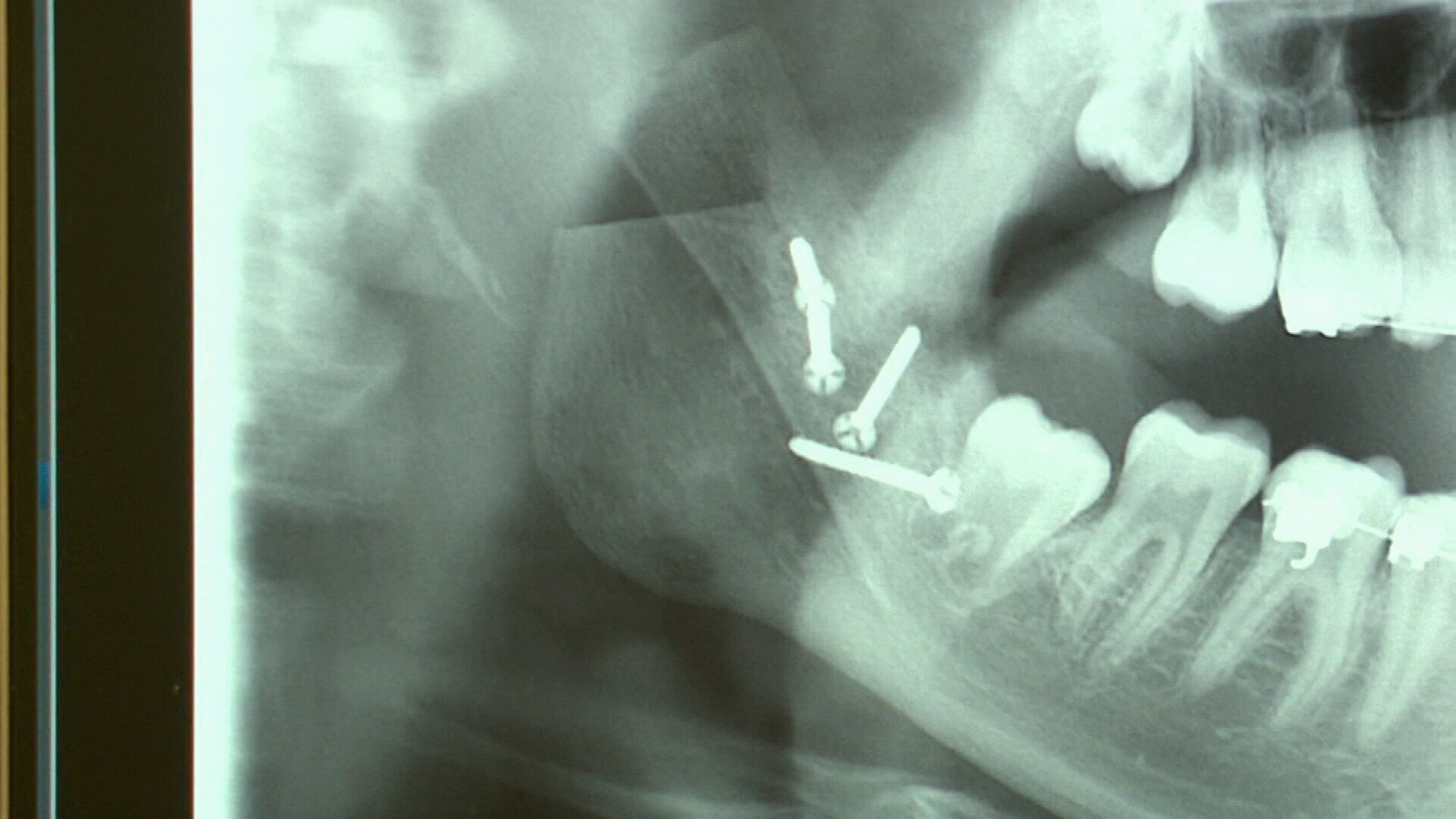 FIBRO‐SARCOMA OF THE LOWER JAW - HAMILTON - 1945 - Australian and New  Zealand Journal of Surgery - Wiley Online Library