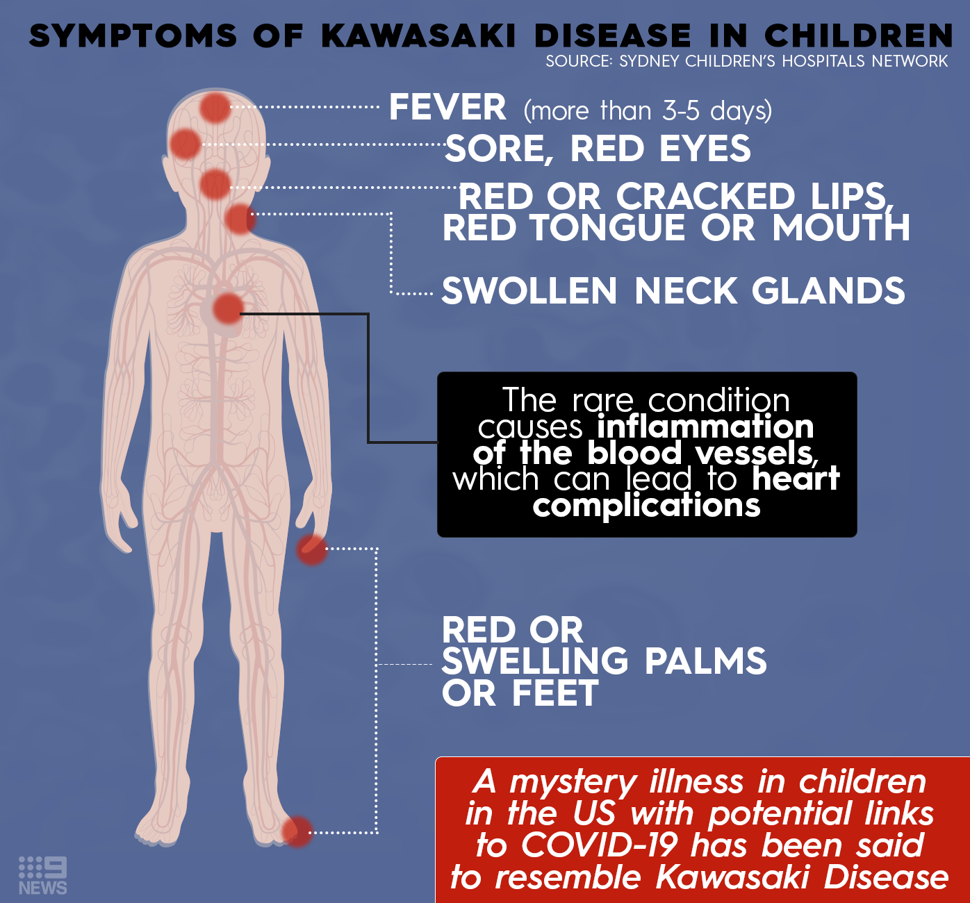 Symptoms of Kawasaki Disease in children.