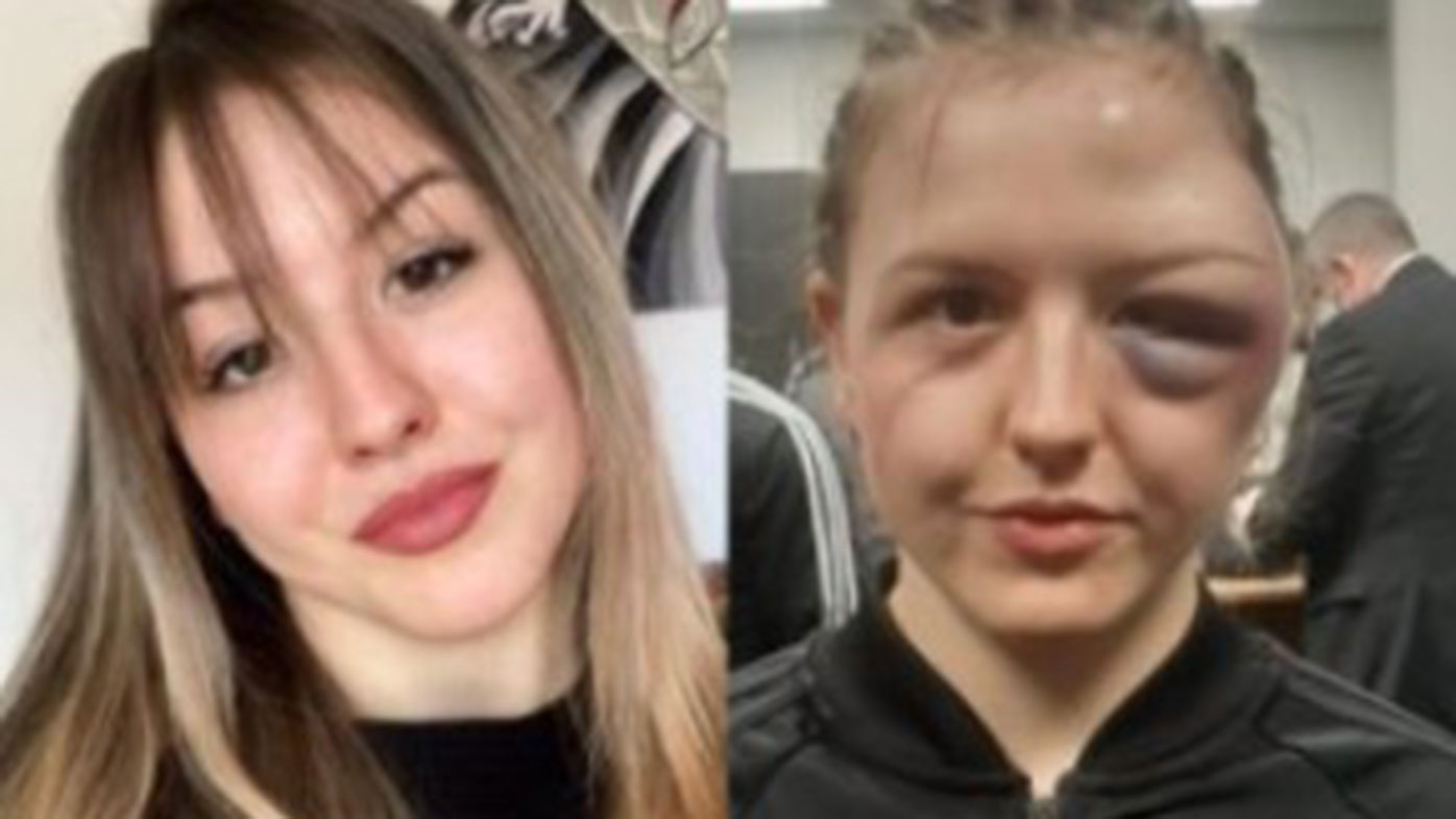 German boxer Cheyenne Hanson in a 'before and after' shot showing her black eye from an accidental head clash.